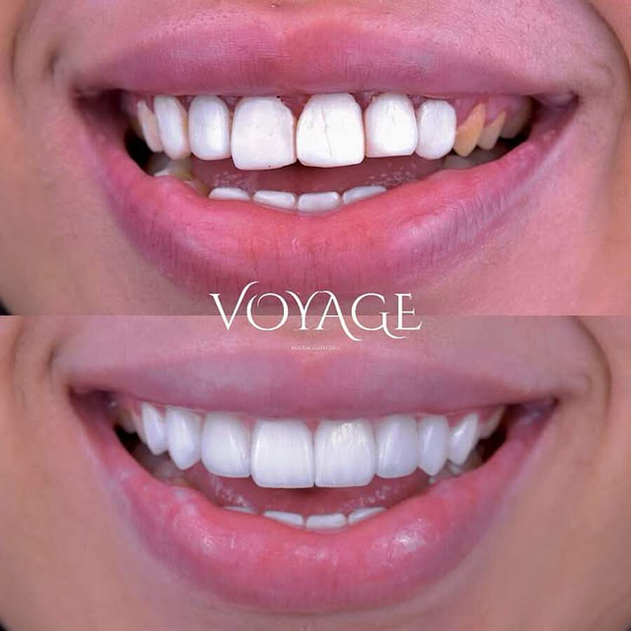 Before and after porcelain veneers on the upper arch, showing corrected shade, length and midline