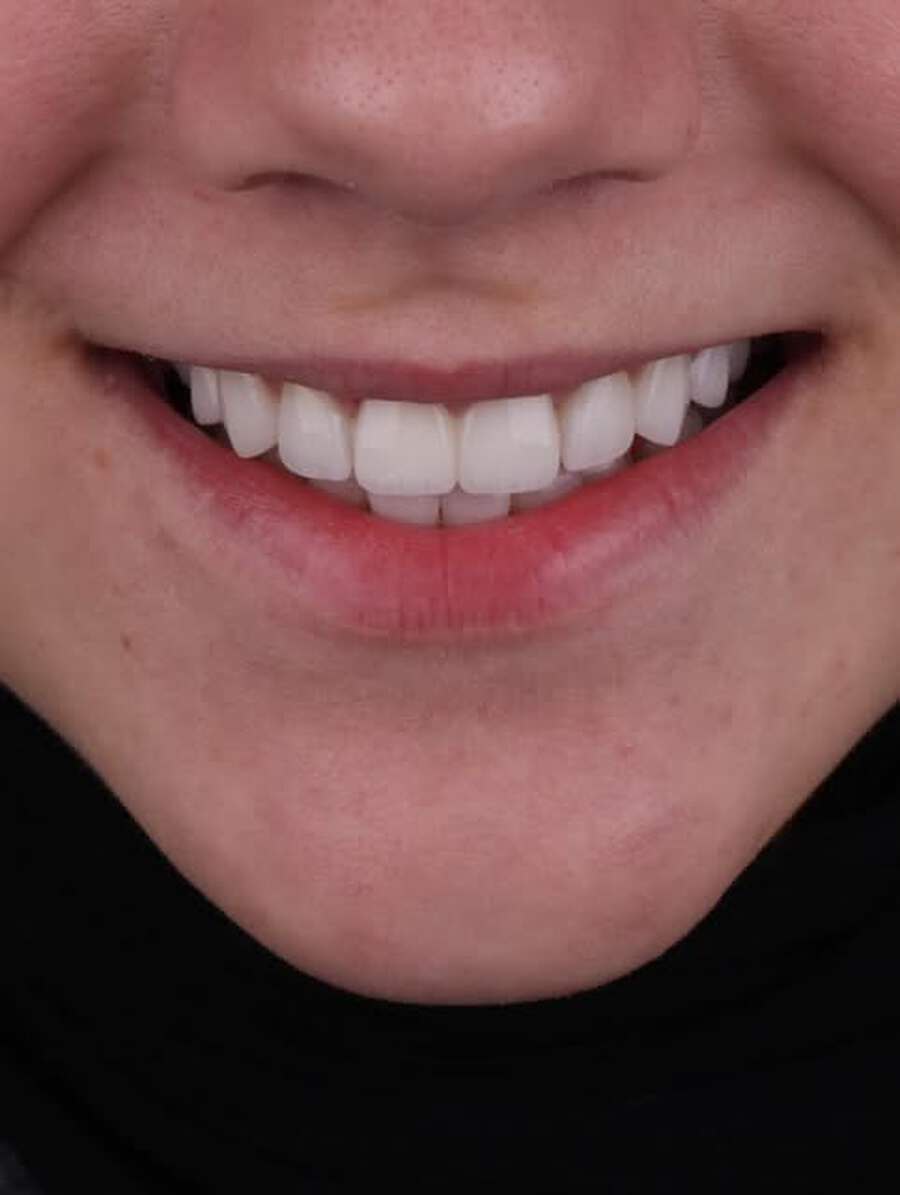 Close-up of a patient's smile after cosmetic treatment at Voyage Dental Aesthetics in New Cairo
